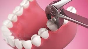Read more about the article اسعار خلع الاسنان في الرياض