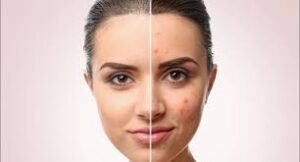 Read more about the article ماهو الفراكشنال ليزر و ما هي مميزات وعيوب الفراكشنال ليزر