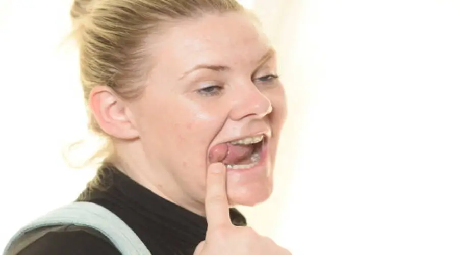 ماسبب فطريات الفم؟ وأهم العوامل اللي بتسببها أنواع فطريات الفم