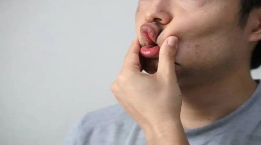 You are currently viewing ماسبب فطريات الفم؟ وأهم العوامل اللي بتسببها