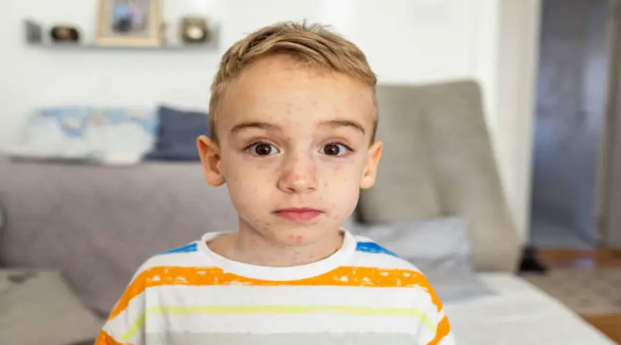 أماكن ظهور حبوب العنقز