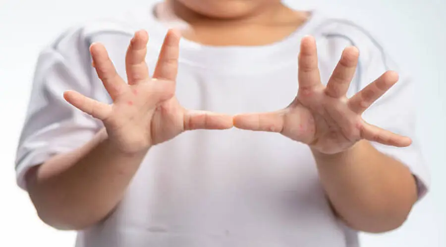 العنقز بعد التطعيم
